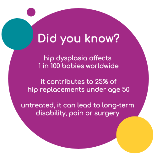 hip dysplasia affects 1 in 100 babies